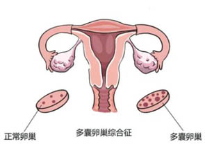 双侧多囊卵巢做试管婴儿的成功率高吗？